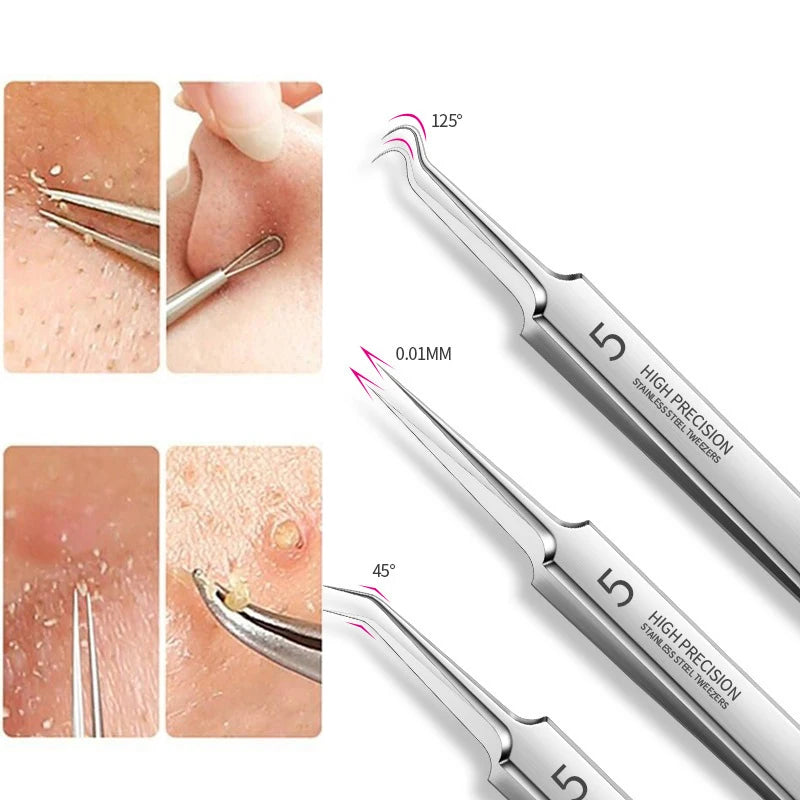 "Blackhead remover tool" "Acne treatment tools" "High-precision tweezers" "Stainless steel tweezers" "Blackhead extraction tool" "Professional facial tools""Health""Acne"